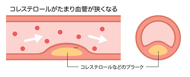 動脈硬化のイメージイラスト